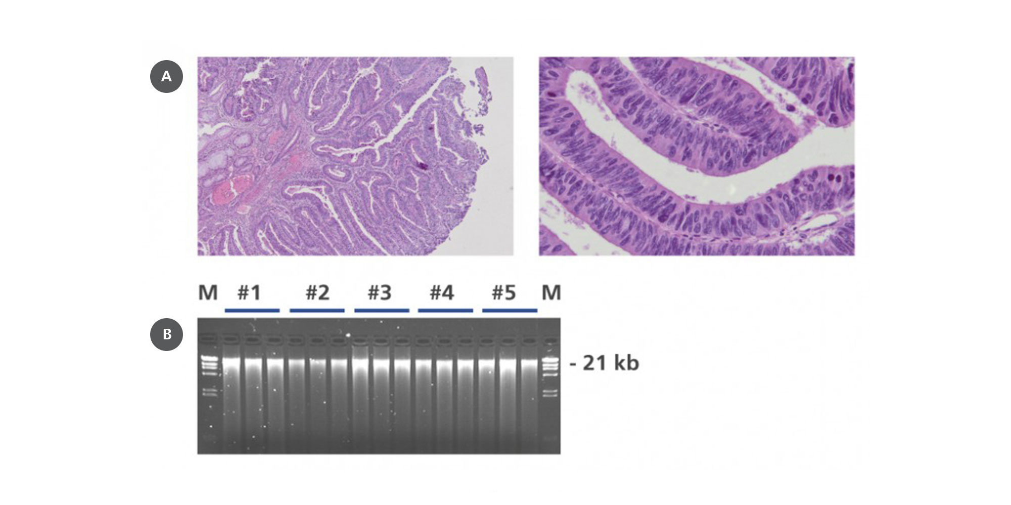 (A) Hematoxylin and eosin (H&E) staining of PAXgene Tissue-fixed, paraffin-embedded (PFPE) human colorectal cancer tissue and (B) DNA on agarose gel electrophoresis using 0.8 % TBE buffered gels with 200 ng genomic DNA isolated in triplicate from five cases (#1–5) of human PFPE colorectal cancer. M: markers.