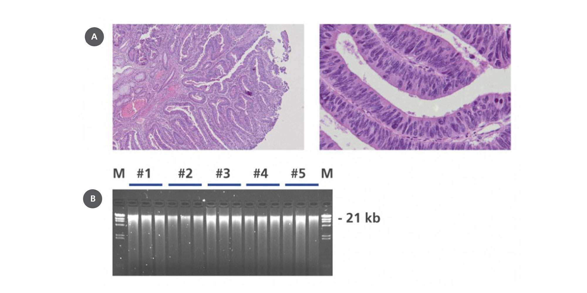 (A) Hematoxylin and eosin (H&E) staining of PAXgene Tissue-fixed, paraffin-embedded (PFPE) human colorectal cancer tissue and (B) DNA on agarose gel electrophoresis using 0.8 % TBE buffered gels with 200 ng genomic DNA isolated in triplicate from 5 cases (#1–5) of human PFPE colorectal cancer. M: markers.