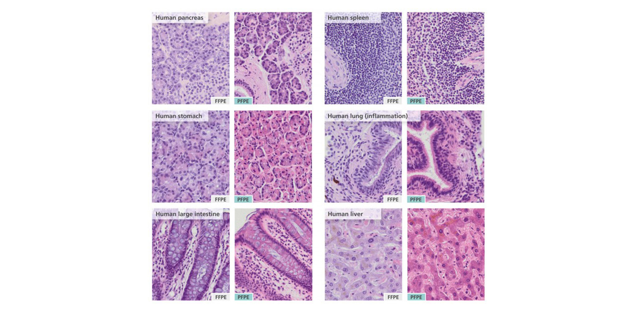 Human tissue samples were divided into 2 sub-samples. One sub-sample was fixed with PAXgene Tissue FIX and the other half was fixed in neutral-buffered formalin. The fixed tissues were embedded in paraffin, sectioned and stained with hematoxylin and eosin. PFPE: PAXgene Tissue-fixed, paraffin-embedded; FFPE: formalin-fixed, paraffin-embedded.